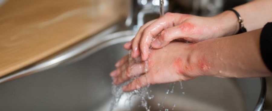 Imagen Qué hacer frente a lesiones por quemaduras