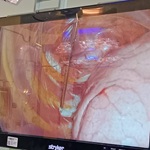 Imagen Cirugía con crioanalgesia favoreció recuperación de adolescente