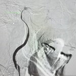 Imagen Unidad Neurovascular resolvió caso de ACV de Urgencia de Curicó